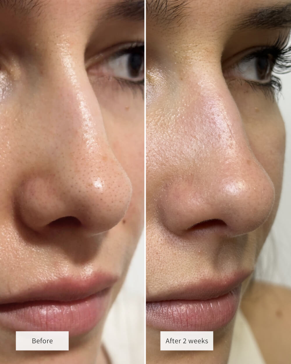 Hydrochloride Blackheads Removing Nose Patches