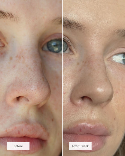Hydrochloride Blackheads Removing Nose Patches