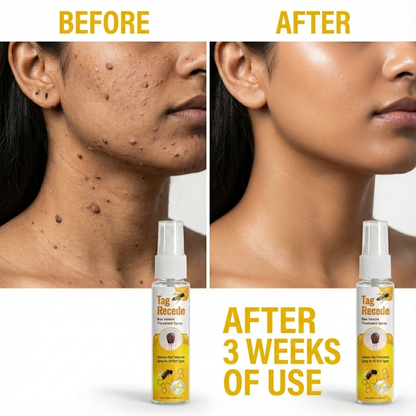 Wart & Skin Tag Remover Spray