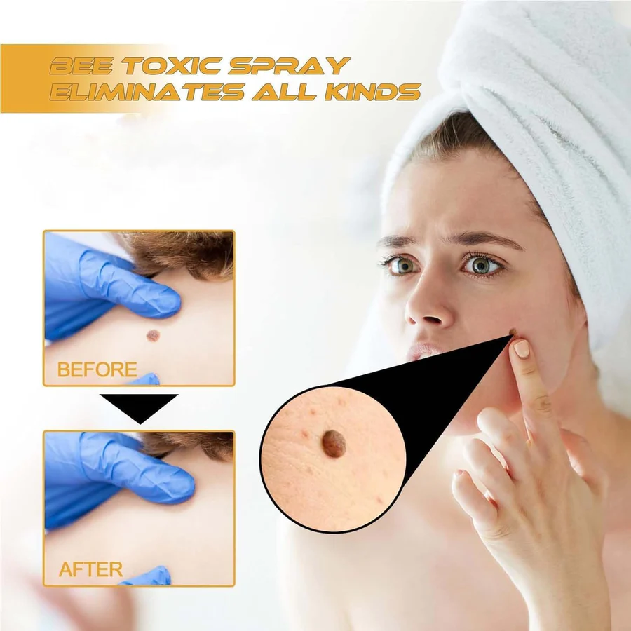 Wart & Skin Tag Remover Spray