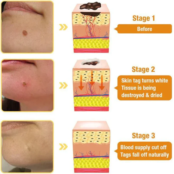 Wart & Skin Tag Remover Spray